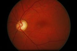 Aspectul discului optic in glaucom