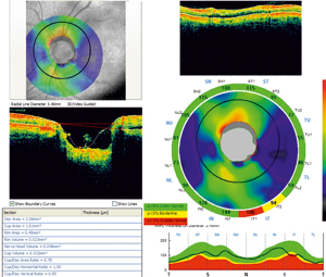 Masurarea parametrilor discului optic si stratului fibrelor nervoase