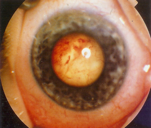 retinoblastom