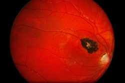 Toxoplasmoza oculara congenitala legata de varsta