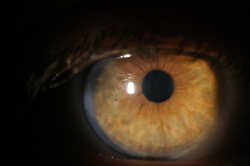 Ochi operat de cataracta