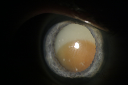 Imagine ochi cu cataracta hipermatura
