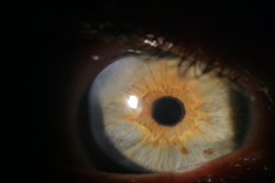 Imagine ochi operat de cataracta