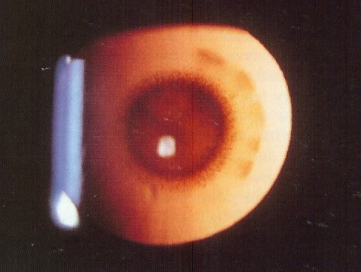 Cataracta congenitala