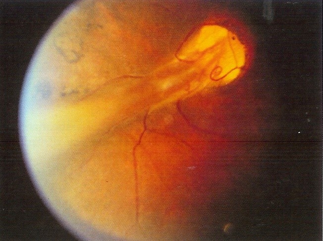 retinopatia prematuritatii