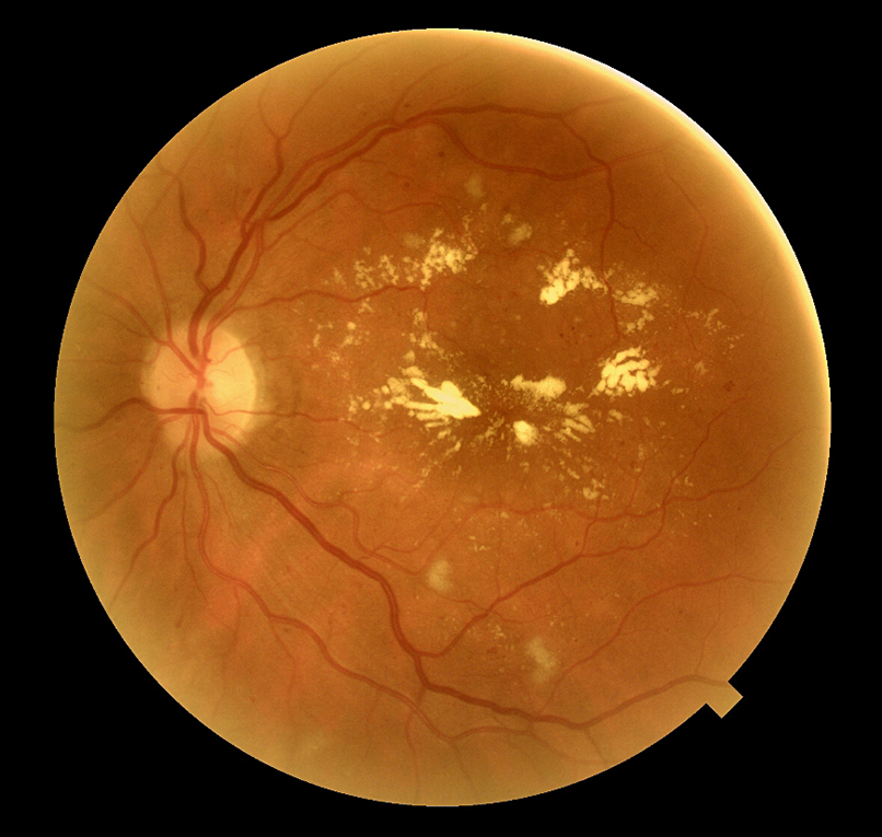 Retinopatia_diabetica_Novaoptic