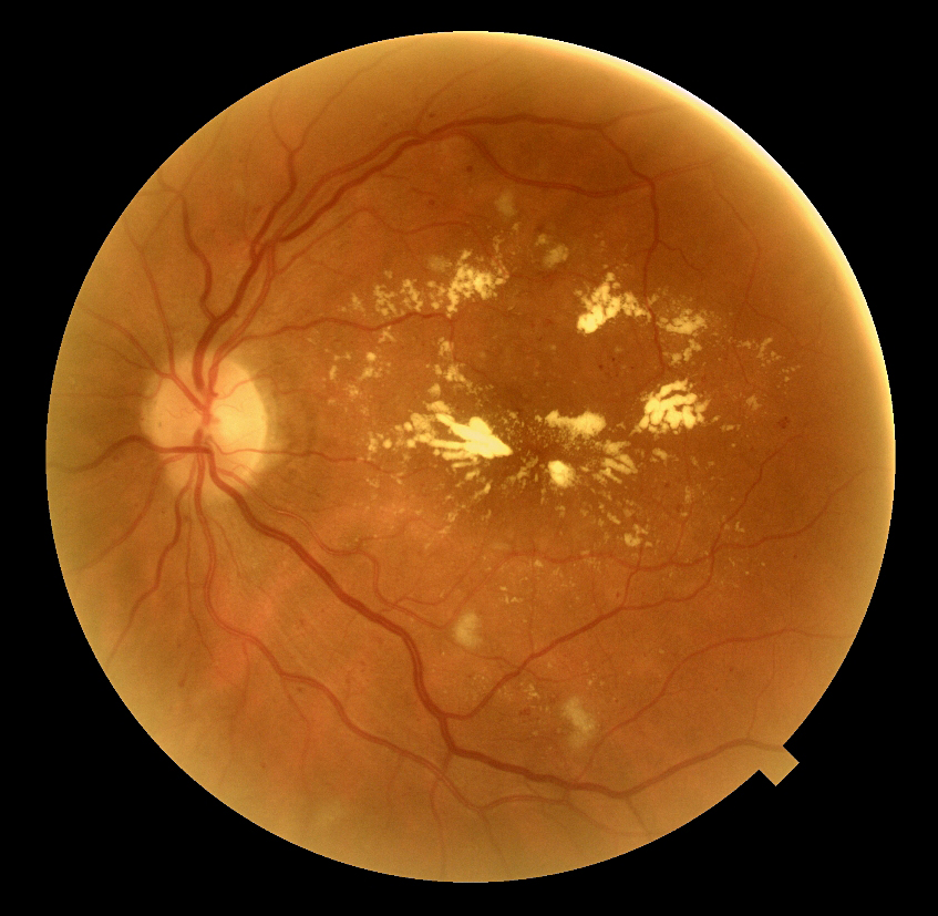 Fotografie FO retinopatie diabetica neproliferativa