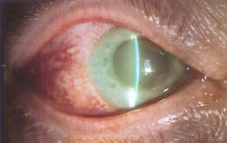 glaucomul este posibil să restabilească vederea