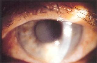 glaucomul este posibil să restabilească vederea cu