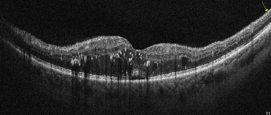 Retinopatia neproliferativa