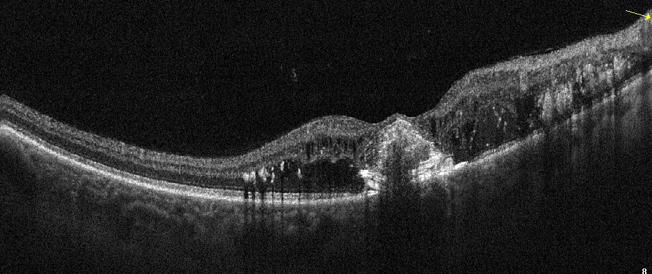 Retinopatia proliferativa