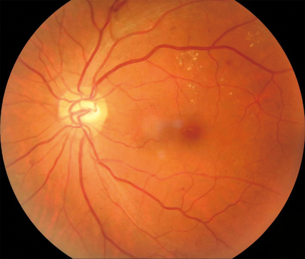 Retinopatie_diabetica